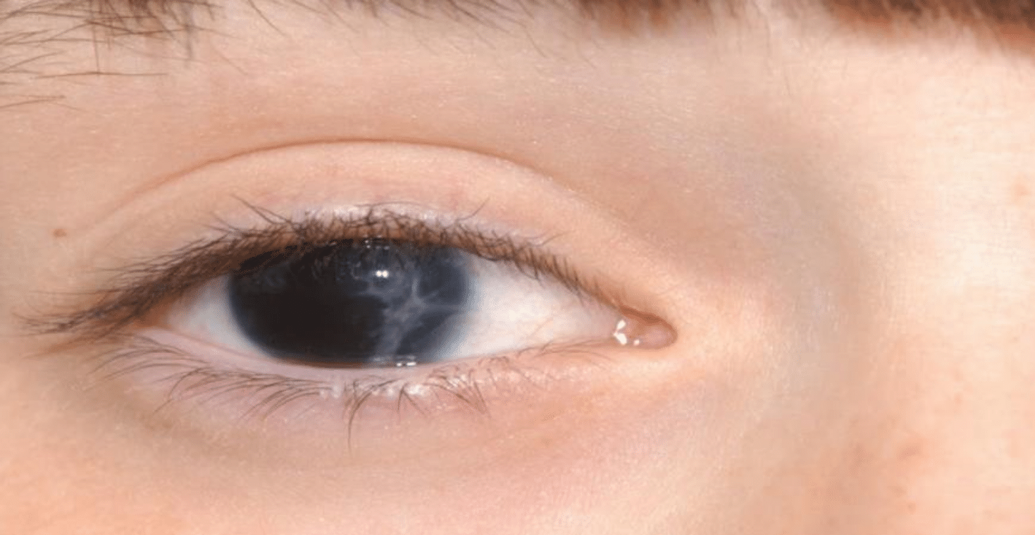um olho (Aniridia)