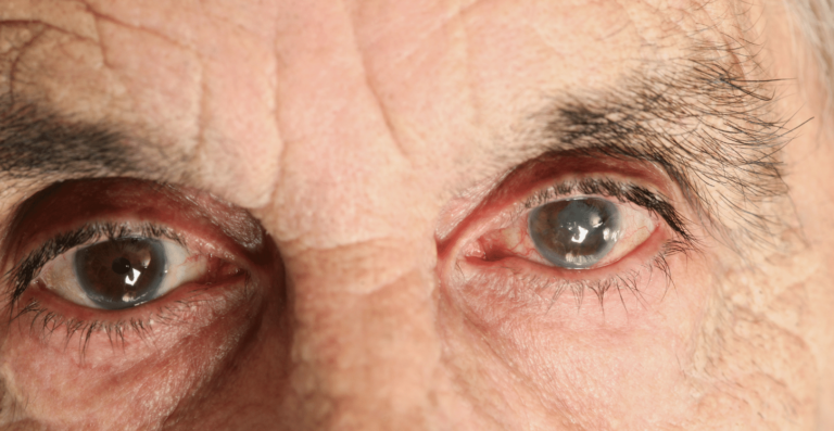 Leia mais sobre o artigo Glaucoma