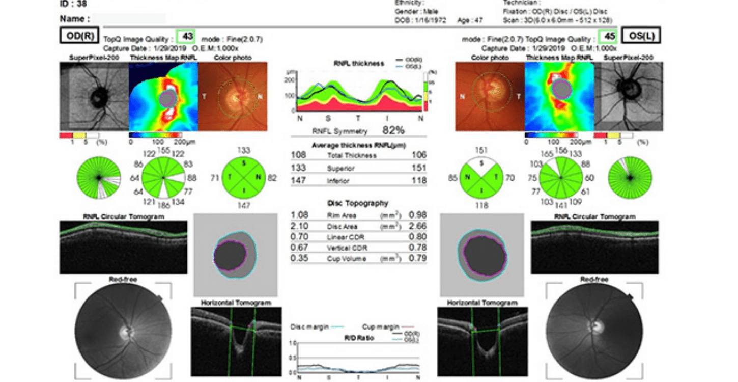Você está visualizando atualmente Tomografia de Coerência Óptica OCT Segmento Posterior