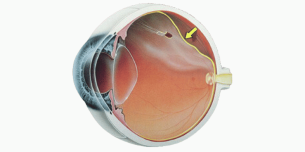 Descolamento de retina: sinais de alerta e formas de tratamento 