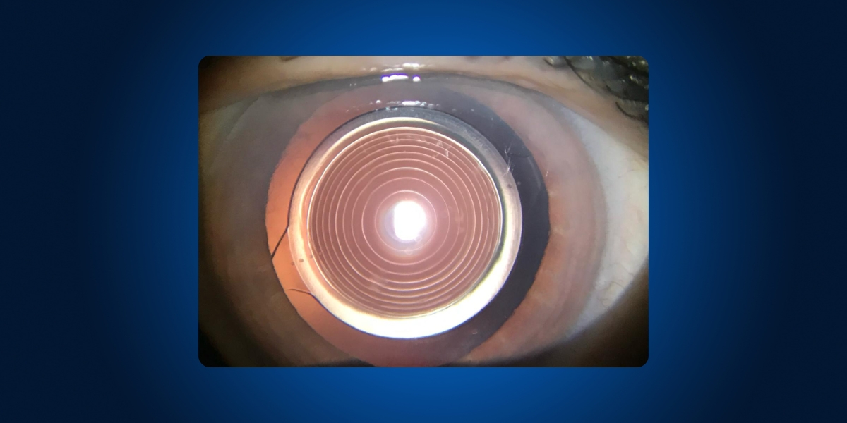 lente intraocular